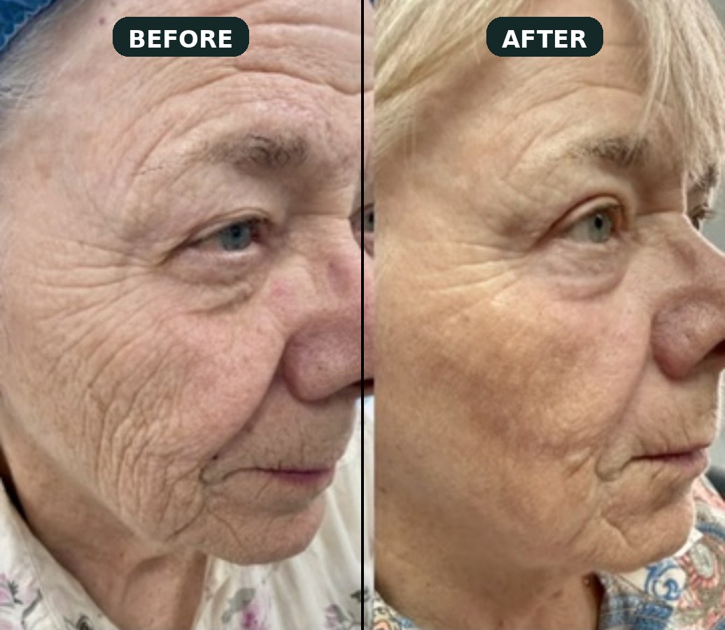 Before and after fractional CO2 laser resurfacing — periorbital lines and cheek texture, patient of Dr. Peter Malouf.