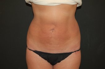 Smarter Lipo body contouring under local tumescent anesthesia at Malouf Dermatology.