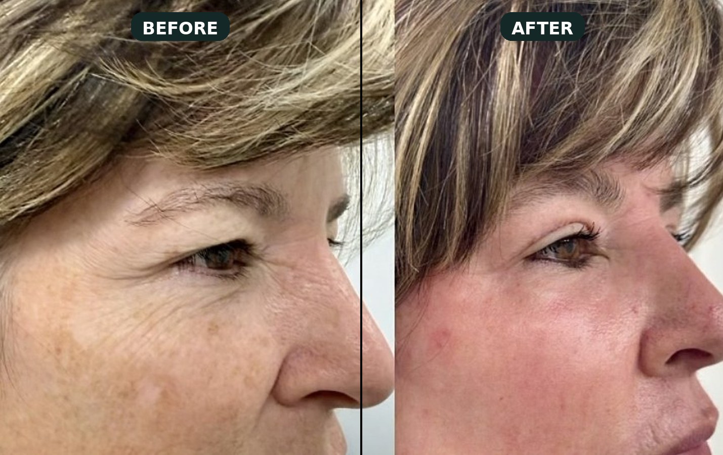 Upper-lid blepharoplasty result — refreshed, less-hooded eyes.