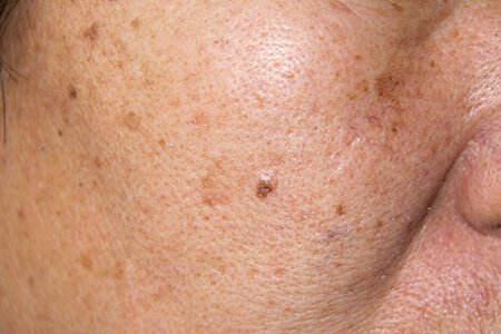 Can Dark Spots be Treated?: Specialists in Dermatology PLLC